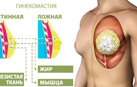Гинекомастия
